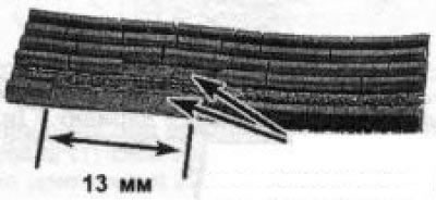 Утрата двух или более соседних ребер на участках протяженностью более 13 мм